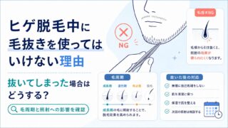 ヒゲ脱毛中に毛抜きを使ってはいけない理由｜抜いてしまった場合はどうする？